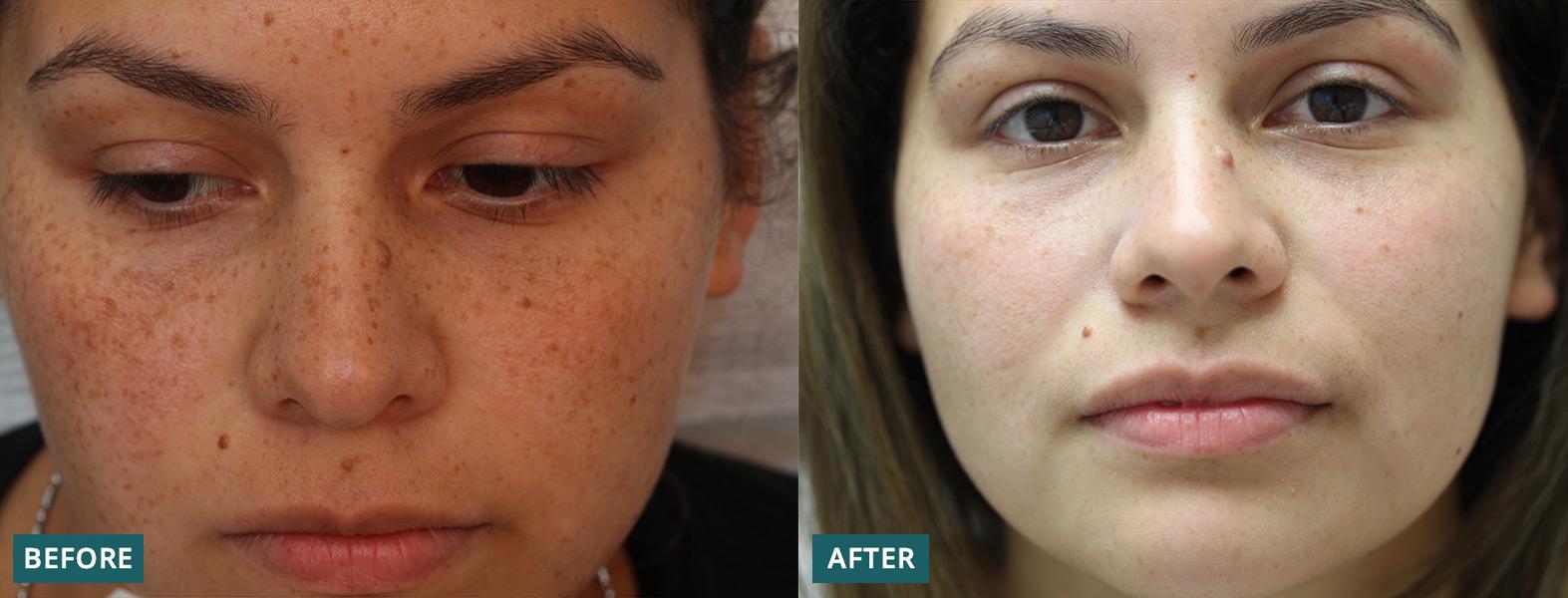 Laser Freckle Removal: A Comprehensive Guide