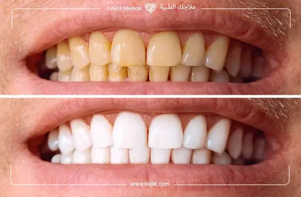 Natural Home Remedies for Teeth Whitening
